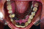 Figure 23 Upper partial denture seated.