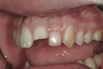 Figure 2 As this left lateral view illustrates, the injury to tooth No. 10 was
extensive; approximately 90% of the tooth was fractured.