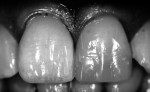 Figure 10. Close-up view of the proposed shade
with the patient’s dentition in black and white.