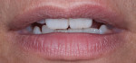 Figure 18. View of the restoration tried in patient’s mouth with lips at rest.