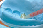 Figure 2 Integrity Multi-Cure Temporary Crown and Bridge Material is injected into the matrix carrier impression and seated into the mouth for 90 seconds.