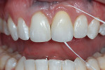 Figure 21  The restoration was designed to allow the patient to be able to remove plaque and debris accumulating at the soft tissue-restorative interface. Floss must pass readily through the contacts and over the flat or convex apical areas to be abl