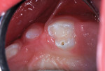 Figure 1 Class VI caries lesion in 18-month-old girl.