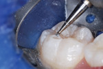 Figure 6 Inverted cone used for caries removal and
preparation.