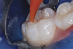 Figure 11 Resin-based composite injected.