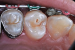 Figure 14 Class VI caries lesion in 14-year-old girl.