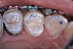 Figure 18 Occlusal contacts
evaluated.
