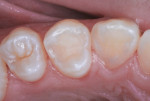 Figure 19 Restored and sealed premolar, 24 months after treatment.