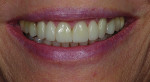 Case 2 post-treatment. Fixed ceramic bridges on teeth No. 6 through No. 8 and No. 9 through No. 11 provided pleasing, natural-looking esthetics.