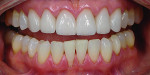 Case 3 post-treatment full smile and retracted
views. Follow-up demonstrated excellent healing and esthetic results final results and occlusal stability was confirmed.