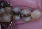 Figure 1 Preoperative condition of old amalgam restorations with gray staining and generalized microleakage.