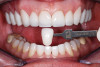 (3.) Restoration of tooth No. 31.