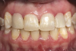 Figure 1  The patient as she presented pretreatment, wearing the existing partial denture. Note the decalcification and discoloration.