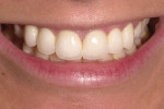 Figure 17  The smile view shows the desired bright color with a subtle hint of the patient’s orange hue showing.