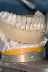 Lateral view of completed mandibular restorations.