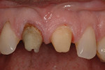 Close up view of staining and lower value of root canal treated tooth No. 8.
