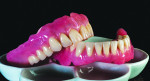 Fig 12. The dentures are cleaned and polished to evaluate for any residual stone or defects.