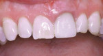 Final post-treatment photo showing significant improvement in the incisal half and the gingival half.