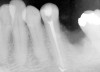 Fig 9. Plenty of natural tooth structure remained, but all 4 maxillary incisors had been endodontically treated.