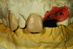 Fig 5b. Wax roughly done for teeth Nos. 6 and 8.