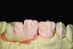 Fig 13. A-1 base dentin is applied.