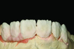 Fig 15. Second buildup consisting of dentin, enamel, and pink porcelain for gingival enamel.