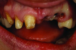 Fig 20. Preparation design for teeth Nos. 6 through 8.
