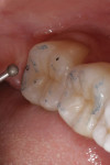 Balancing contacts marked in blue on tooth No. 18.
