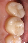 Polished porcelain onlays on teeth Nos. 14 and 15.
