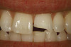 Fig 3. Diagnostics of existing RPDs tell the technician and clinician variables to consider during treatment. Here, there has been severe wear on the patient’s right side. This wear could be due to opposing restorative materials that create wear in acrylic resin denture teeth resulting in loss of vertical dimension of occlusion, which places heavy forces on natural and artificial teeth. Note the wear facets on the right pre-molar area, plus the addition of teeth to partial and the loss or breaking of denture teeth.