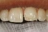 Fig 4. When combining implants as abutments for RPD design, the opposing occlusion or restorative space is extremely important to understand before implants are placed. Here, the planned attachment’s mesial surface is very close to contacting the distal incisal of the opposing tooth. This is a result of poor case planning from implant diagnostics to RPD design.