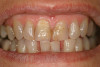 Fig 7. Combination RPD cases with attachments on abutments are an important part of esthetic or cosmetic removable partial dentures. A lingual plate was used due to minimal lingual depth, plus the plate provides a guide for placement on attachments. With this maxillary RPD combination case, minimal metal with maximum support was important. The palatal gingival margins of the crowns was opened 4-6 mm, plus the crowns had a milled surface with a contoured lingual ledge strap.