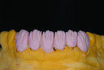 Fig 8 and Fig 9. For this case, a higher chroma dentin is applied cervical and interproximal with higher-value dentins placed in the mid-third.
