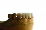 Fig 14 through Fig 17. Restorations on the model before and after polishing.