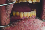 Fig 18 through Fig 20. Definitive restorations seated in the mouth.