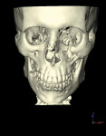 Fractured left orbital floor and nose, 25-year-old man.