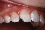 A 10-year-old girl fractured her right central incisor in 1983.