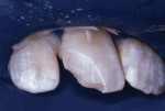 Two months after initial “bandage” repair, the tooth was re-prepared for RBC repair.