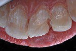 Lingual view prior to placement of dentin replacement liner.