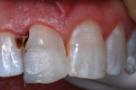 Resin-based composite injected, adapted, and
photocured in three portions.