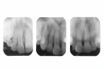 1983 radiograph (left); 32-year postoperative film (center, image taken in June 2015); 9 months after re-repair (right, image taken in February 2016).