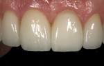 Final restorative outcome (restoration completed by Dennis Hartlieb, DDS, Glenview, Illinois).