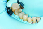Fig 6. Placement of the lower right restorations under rubber dam isolation.