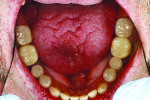 Fig 7. Occlusal view of the mandibular arch after placement of the porcelain crowns and onlays.