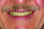 Fig 11. Close-up view of direct composite crowns on maxillary anterior teeth.