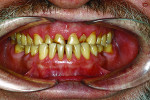 Fig 1. Preoperative view of the teeth in maximum intercuspation (MIP) showed the loss of maxillary anterior tooth structure.