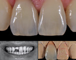 A case in which Connecticut-based ceramist
Cristiana Fragoso delivered what was deemed to
be a perfect restoration to Sivan Finkel, DMD, in
New York on the first attempt.