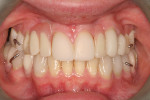 Case 2, posttreatment retracted occlusion with improved midline diastema.