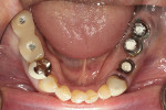 Fig 9. After the removal of the lower left crowns with the direct deprogrammer in place.