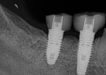 Fig 12. A radiograph confirming proper fit and seating of the final restorations on the lower right.